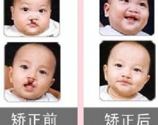 吃兔肉真的會(huì)長(zhǎng)兔唇？為什么會(huì)長(zhǎng)兔唇？